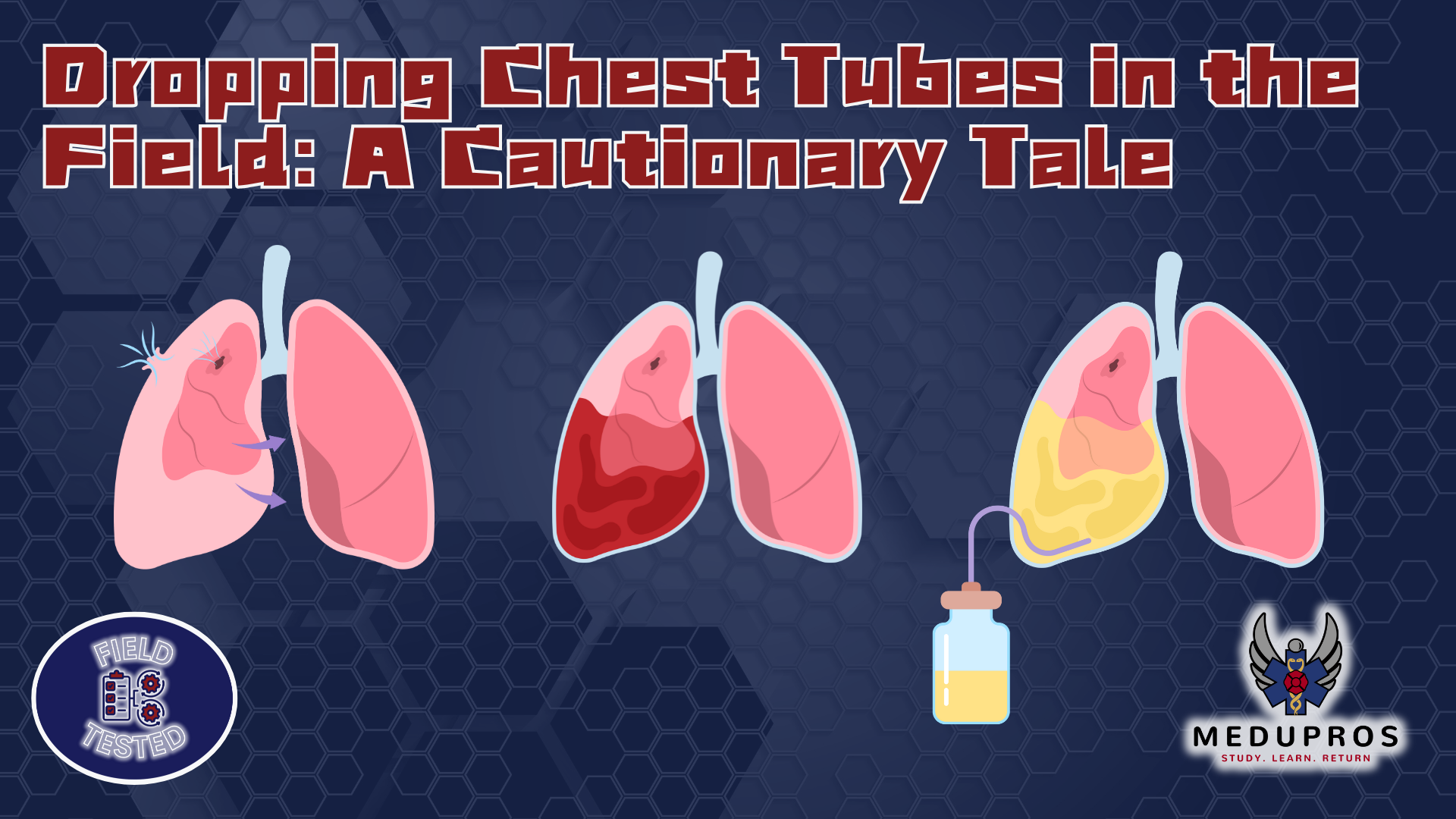 MC|FT: Dropping Chest Tubes in the Field: A Cautionary Tale